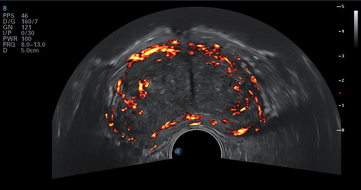 Ultraschallbild nach Analyse durch ANNA/cTRUS
